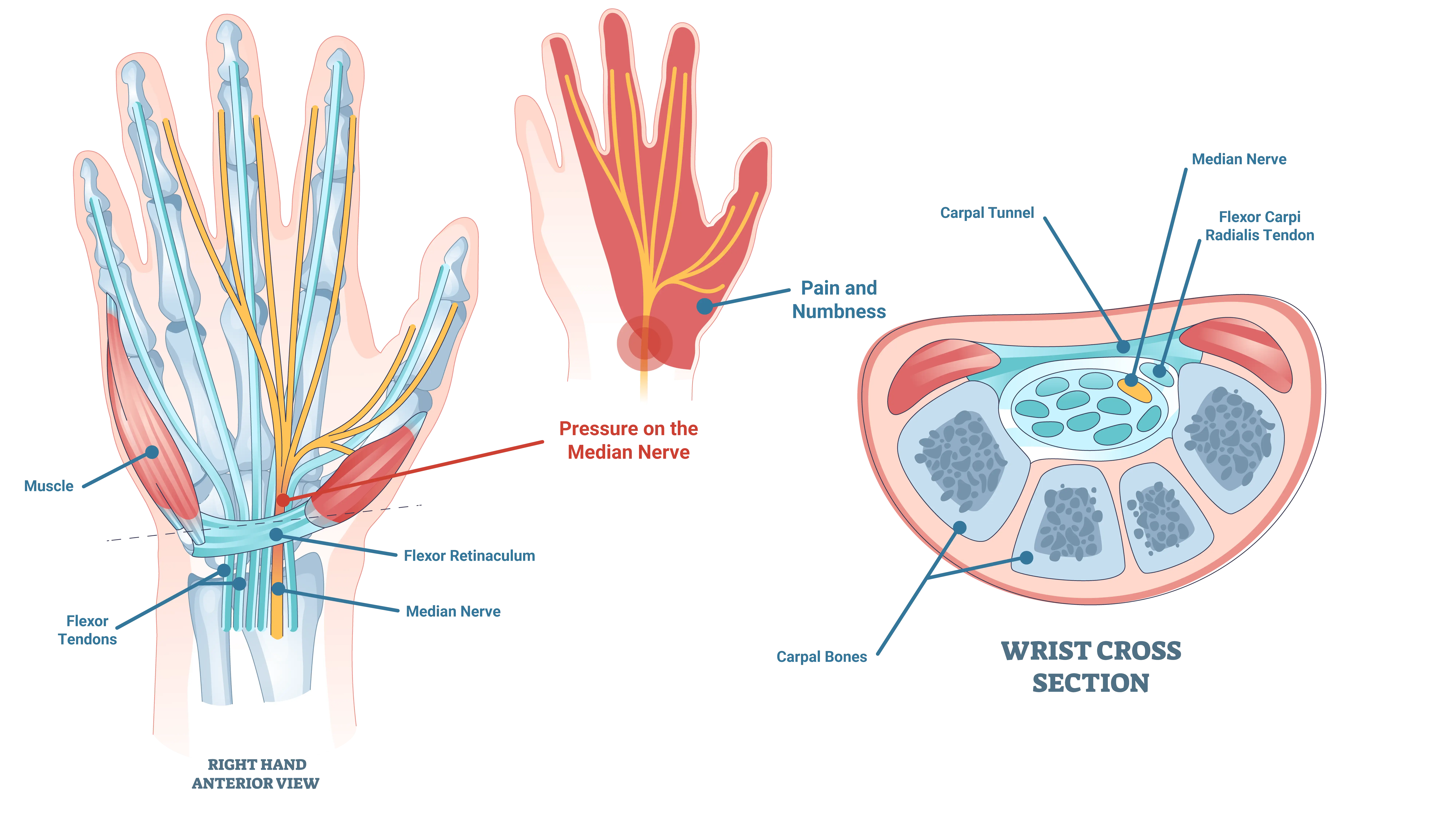 Anatomical Graphic of Carpal Tunnel