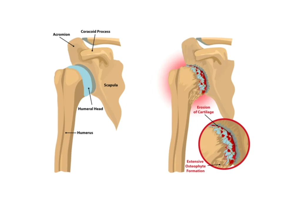Shoulder arthritis