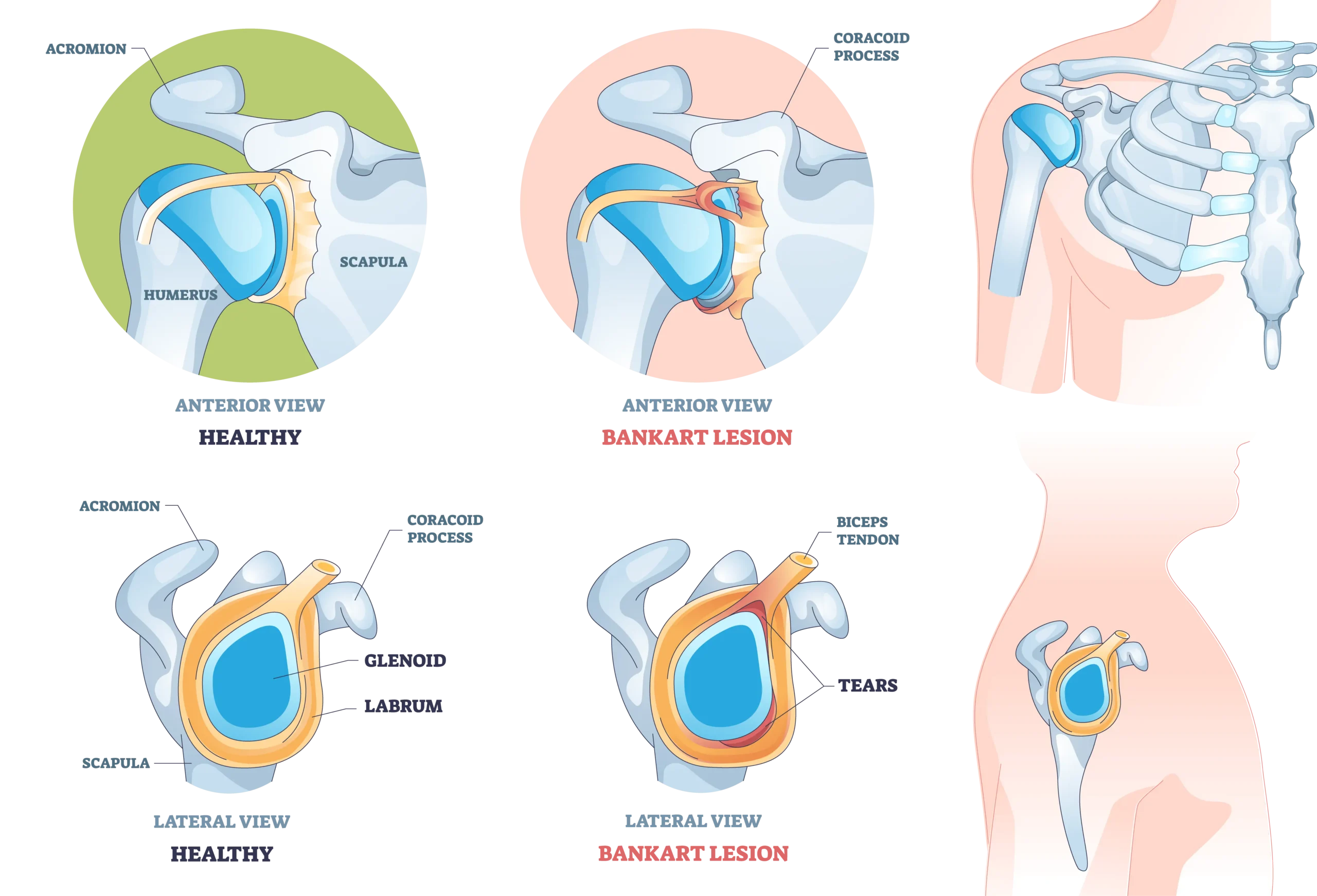 Anatomical Graphic of Bankart Tear