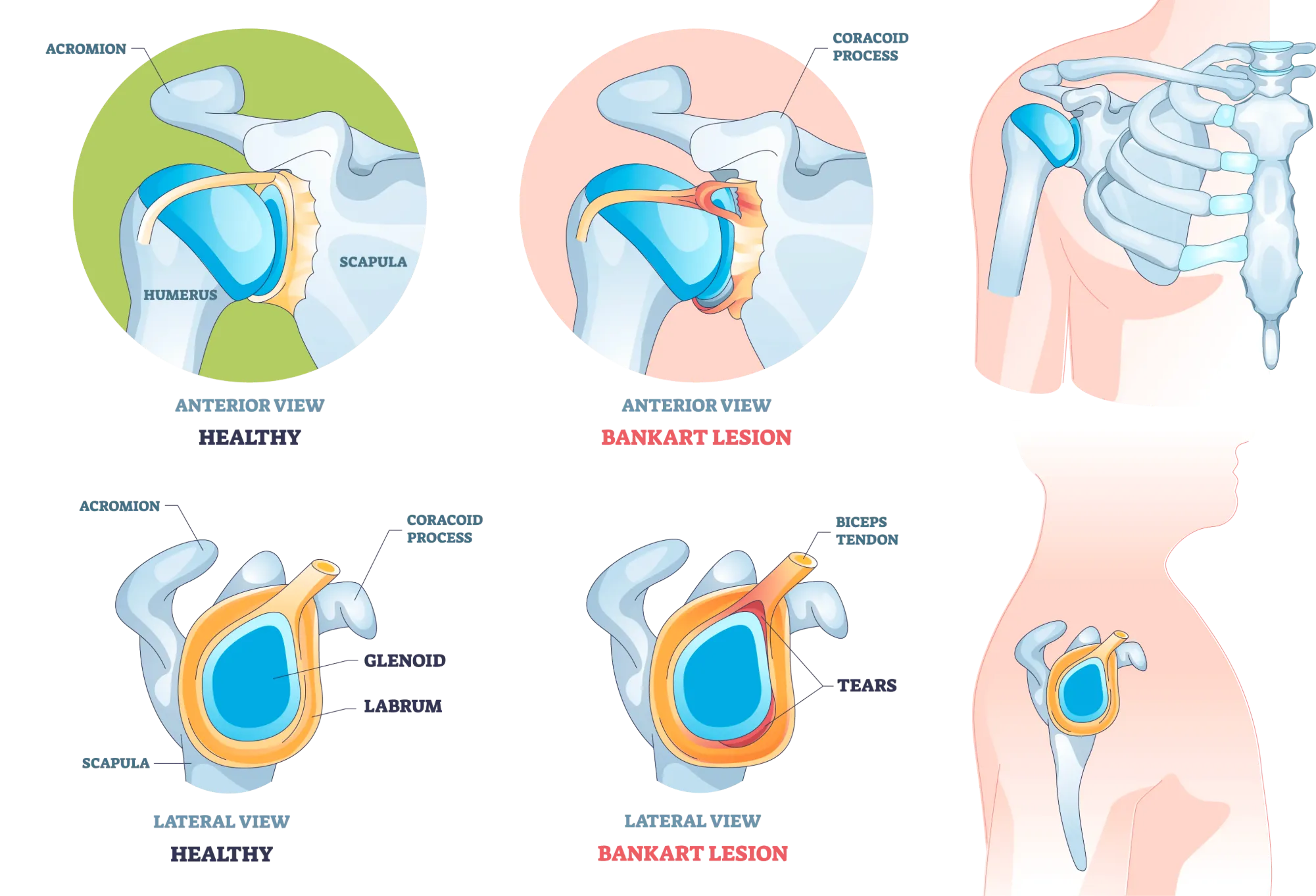 Anatomical Graphic of Bankart Tear