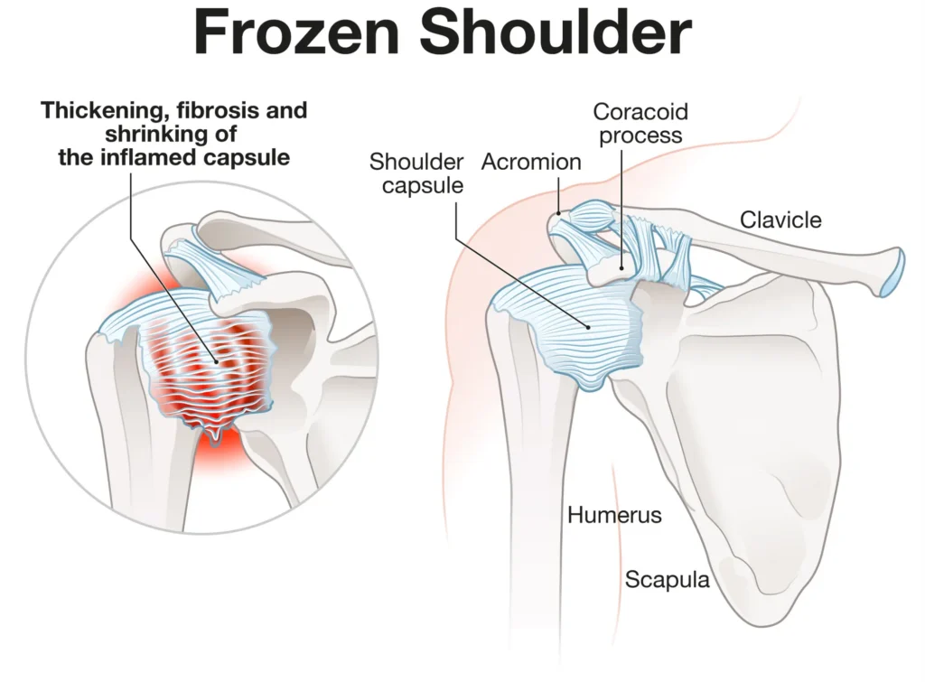 frozen shoulder diagram, with a focus on the normal vs inflamed capsule.