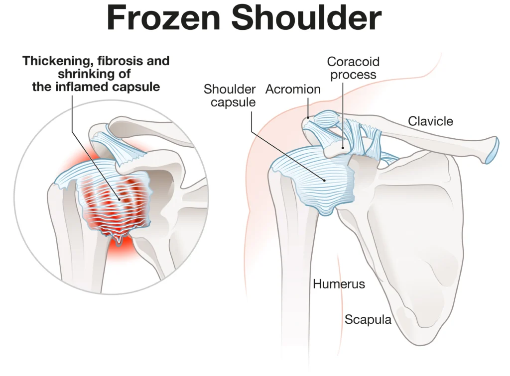 frozen shoulder diagram, with a focus on the normal vs inflamed capsule.