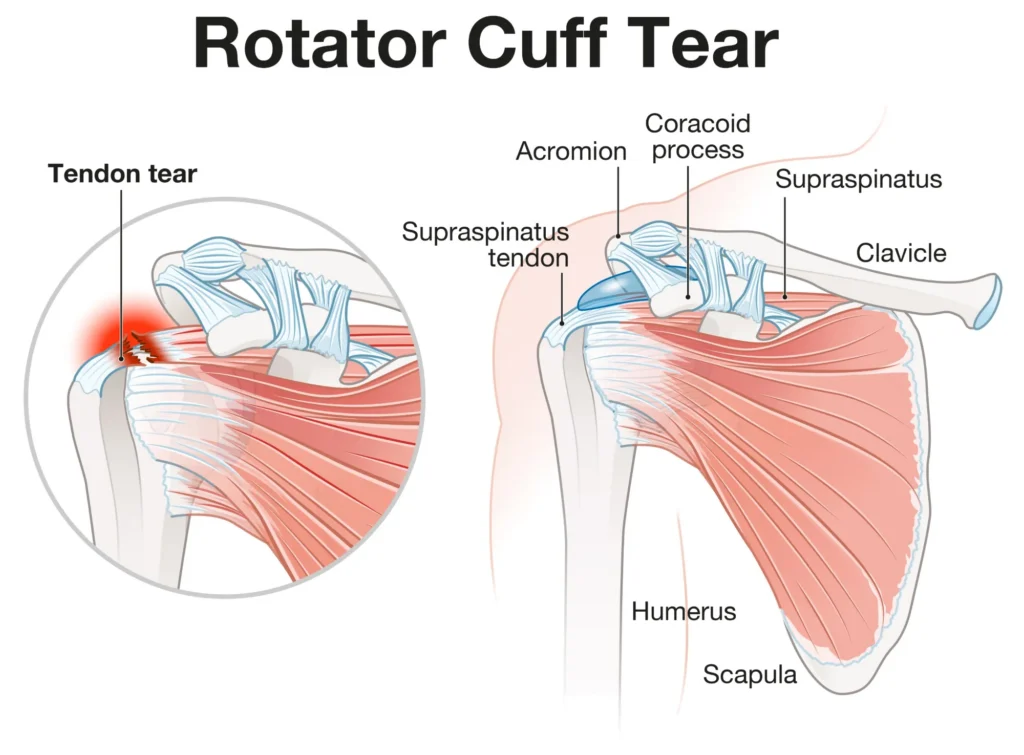 A diagram of a rotator cuff tear, showing the difference between a healthy and torn rotator cuff in the tendon.