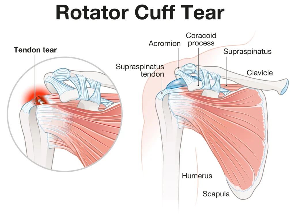 rotator cuff tear A diagram of a rotator cuff tear, showing the difference between a healthy and torn rotator cuff in the tendon.