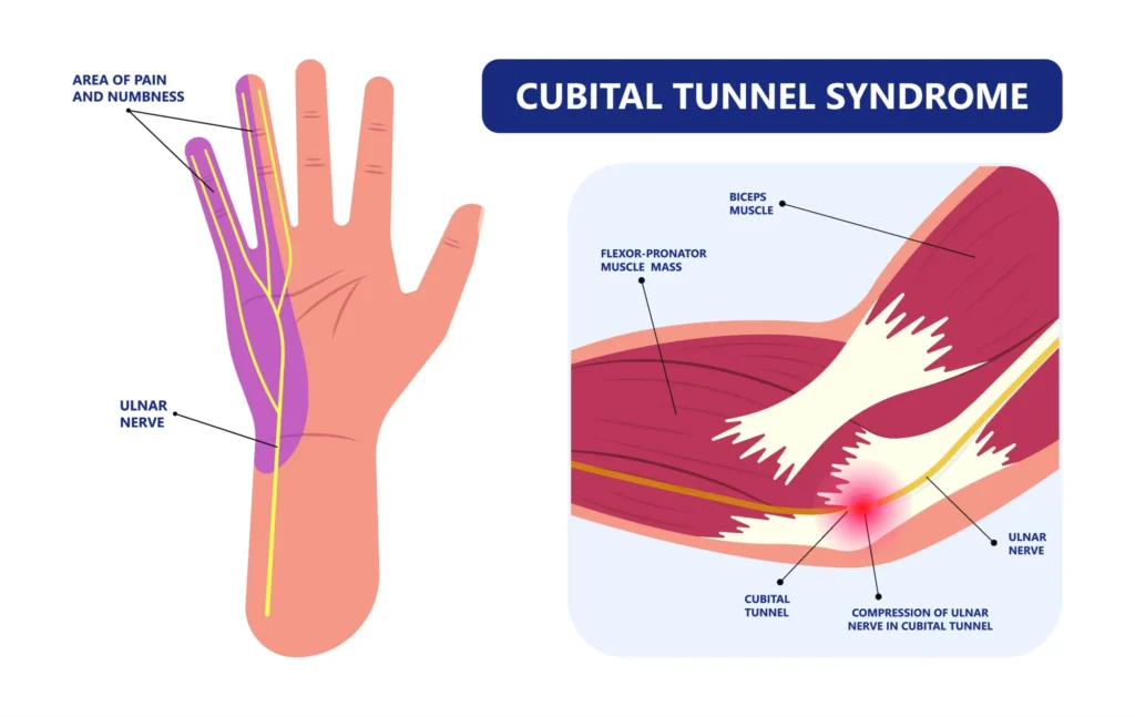 cubital tunnel syndrome cubital tunnel syndrome in the elbow, with a focus on the ulnar nerve.