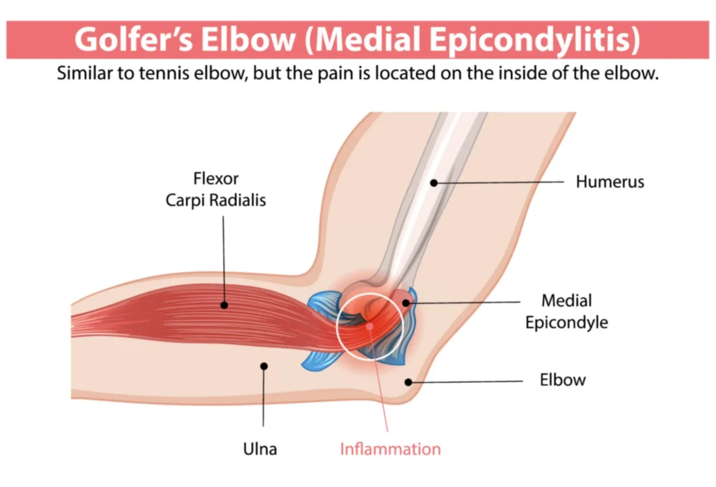 golfers elbow diagram anatomical diagram of golfers elbow.