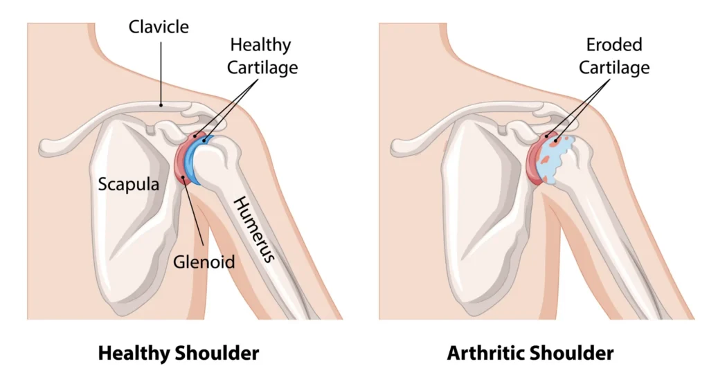shoulder arthritis diagram with a focus on the difference between the healthy and arthritic shoulder.