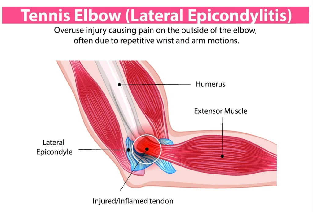 tennis elbow diagram anatomical diagram of tennis elbow.