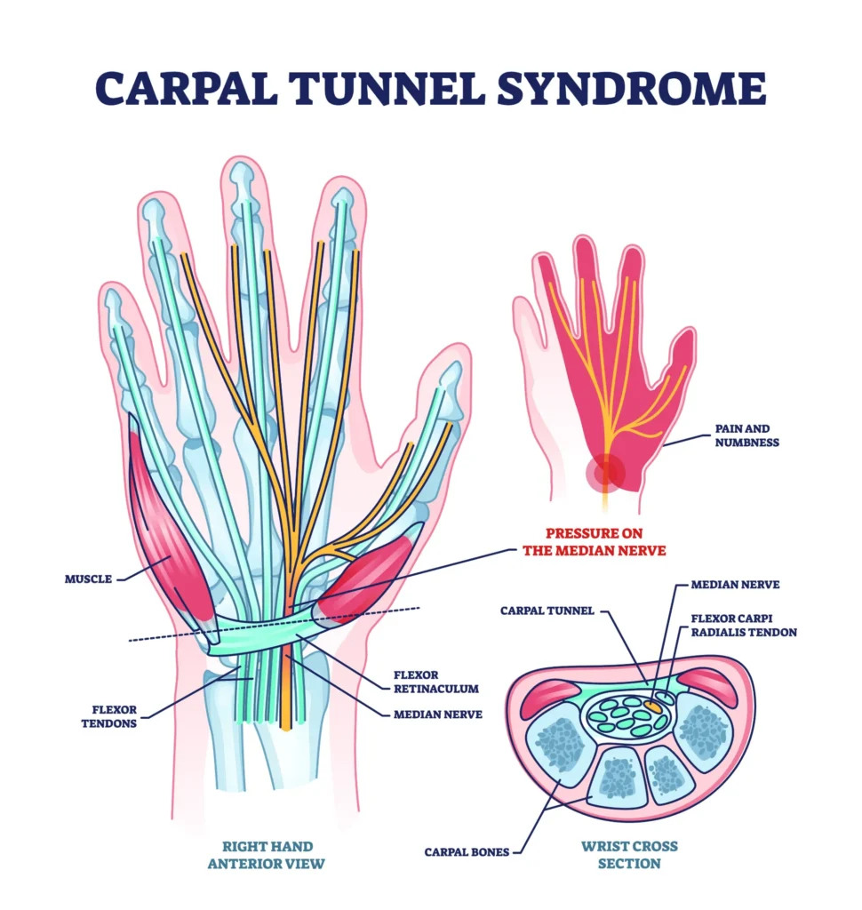 carpal_tunnel_syndrome Diagram of healthy hand to a hand with carpal tunnel syndrome