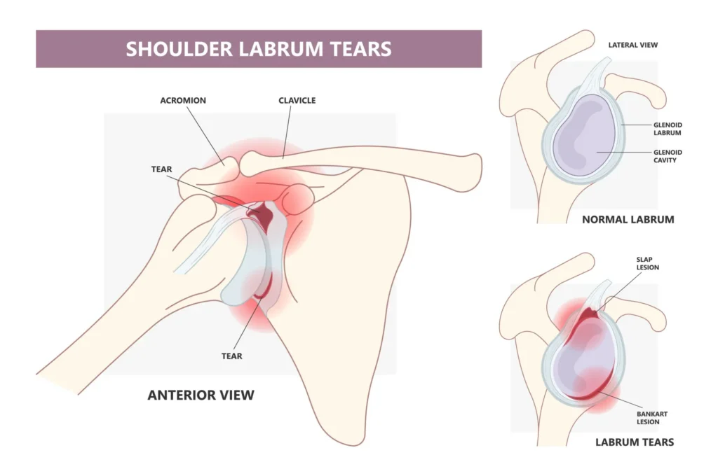 shoulder labrum tear diagram of a shoulder labrum tear, compared to a healthy shoulder