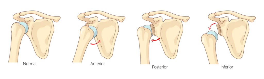 Shoulder dislocation diagram