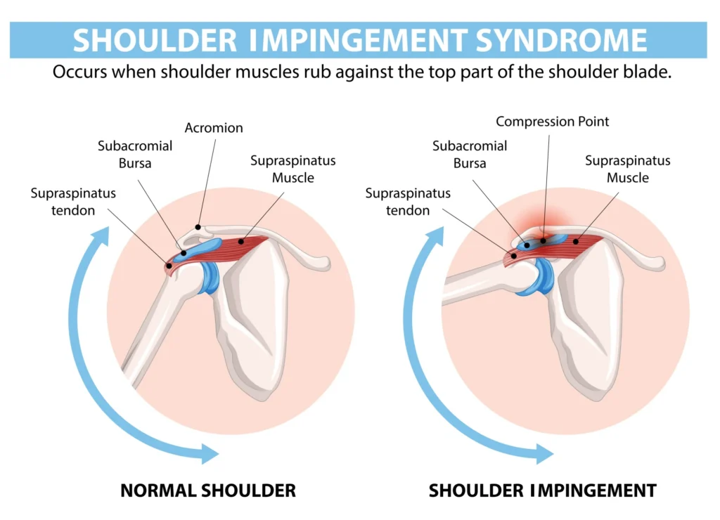 Shoulder impingement diagram.