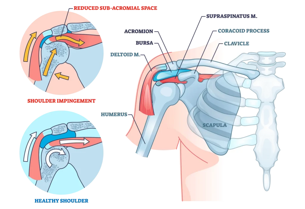 Diagram of shoulder impingement 