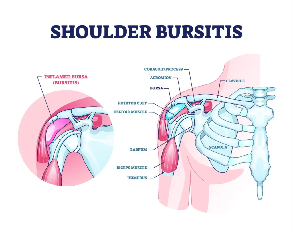 Diagram of shoulder bursitis